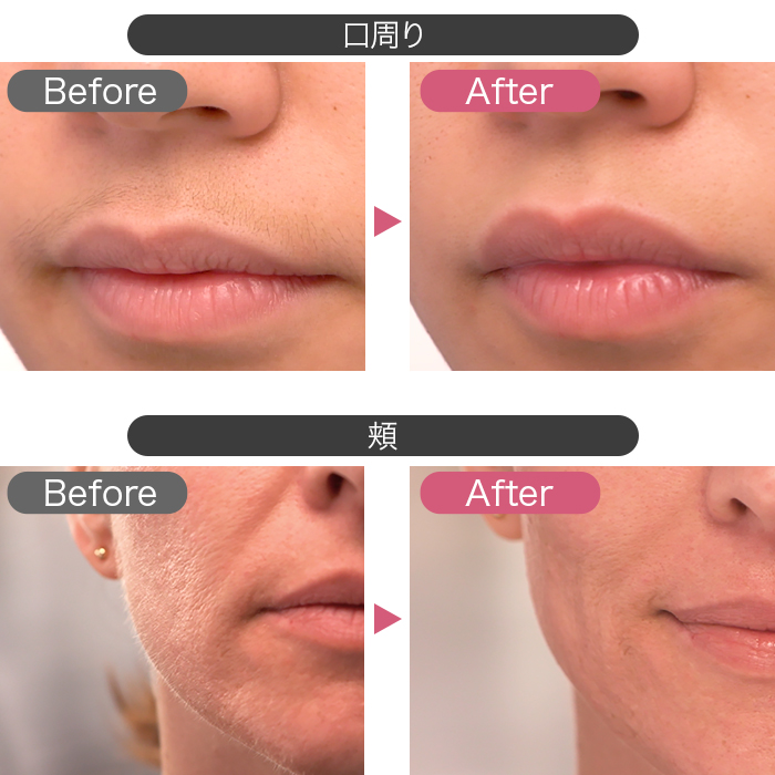 コードレス電動シェーバー フローレス テレビショッピングのropping